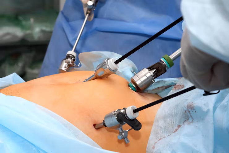 Laser Procedures